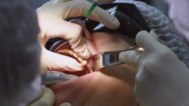 Senior woman getting dental implant — Stock Video