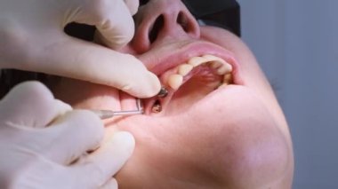 Yaşlı kadın diş implantı yaptırıyor.
