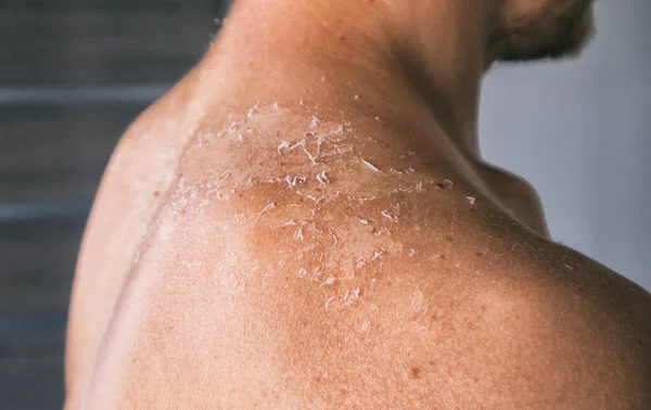 Dry Itching Man Skin Sunbath — Stock Photo, Image