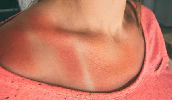 Reddened Woman Skin Sunburn — Stock Photo, Image