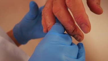 Doktor muayene hasta Dermatit ellerde, closeup ile.