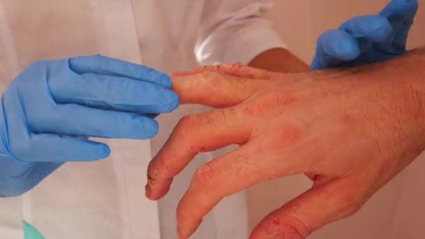 Médico examinando paciente com dermatite nas mãos, close-up . — Vídeo de Stock