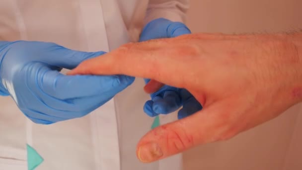 Лікар вивчає пацієнта з дерматитом на руках, крупним планом . — стокове відео