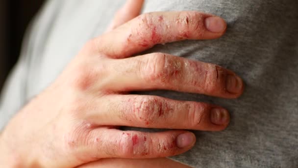 Doigts d'un homme avec psoriasis et eczéma. Un gros plan du pelage de la peau — Video