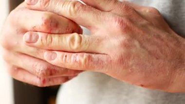 Sedef ve egzama ile bir adamın parmak. Cilt soyma bir close-up