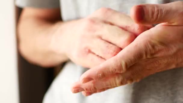 El hombre se rasca las manos. Dedos muy picantes, psoriasis . — Vídeos de Stock
