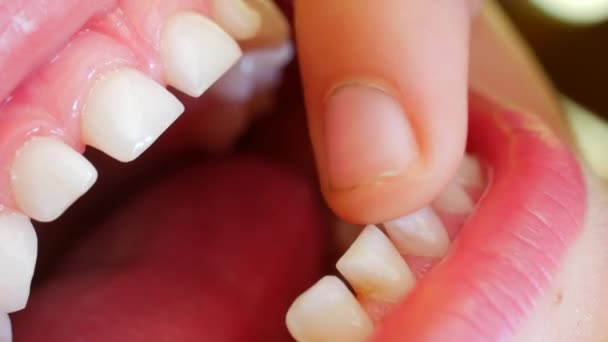 Dítě ukáže svůj první vrávoravý zub. Prst uvolňuje baby zub. — Stock video