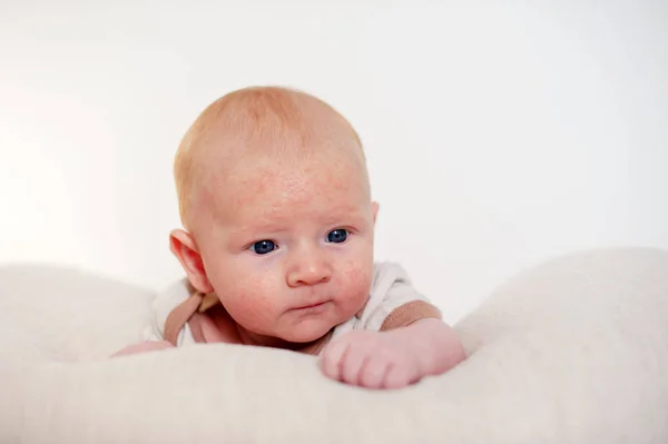 Allergien Neurodermitis Gesicht Eines Babys — Stockfoto