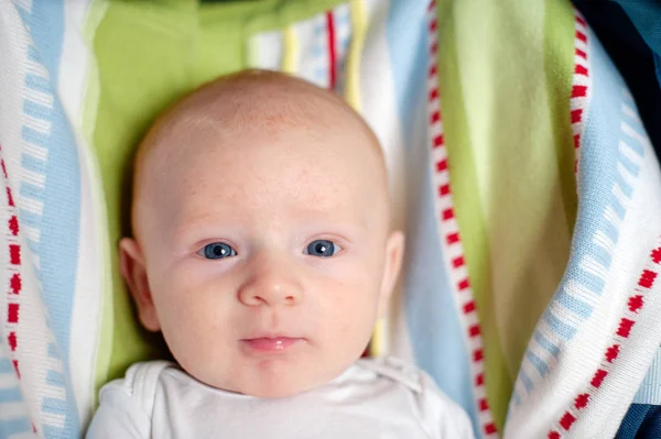 Allergien Neurodermitis Gesicht Eines Babys — Stockfoto