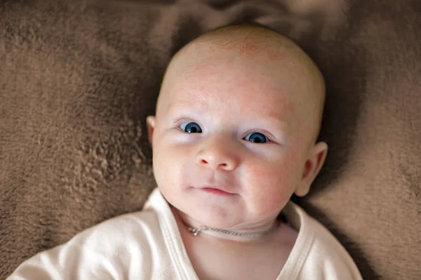 Allergien Neurodermitis Gesicht Eines Babys — Stockfoto