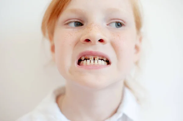 Una Chica Con Caries Dental Displasia Esmalte —  Fotos de Stock