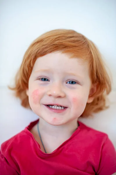 Uma Criança Com Sinais Alergia Rosto — Fotografia de Stock