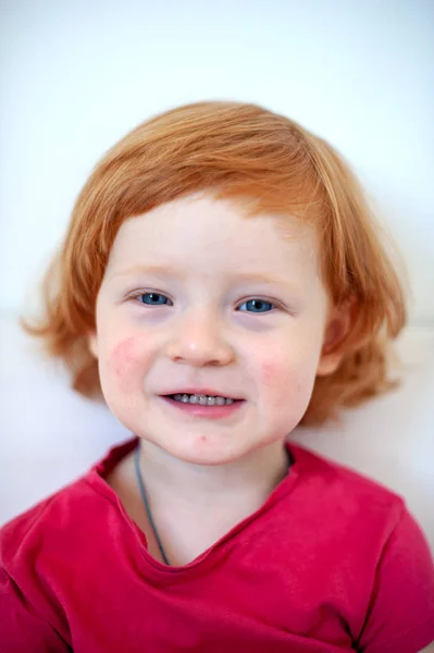 Ett Barn Med Tecken Allergi Ansiktet — Stockfoto
