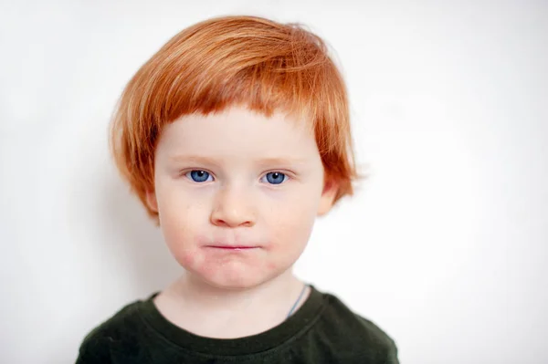 Хлопчик Алергією Обличчя — стокове фото