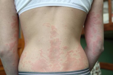 Alerjik Dermatit