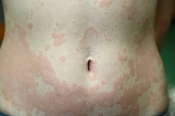 Alergická dermatitida — Stock fotografie