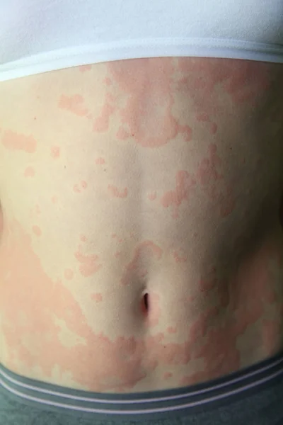 Аллергический дерматит Лицензионные Стоковые Изображения