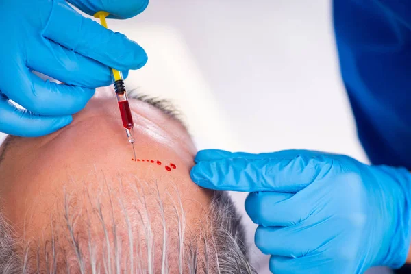 Old man visiting young male doctor in hair transplantation conce — Stock Photo, Image