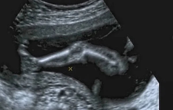 Ultrasonografie Analyse Van Een Maand Fetus Italië — Stockfoto