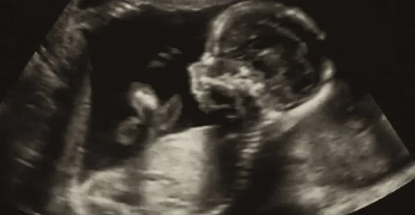 Verloskundige Ultrasonografie Echografie Van Een Vierde Maand Foetus — Stockfoto