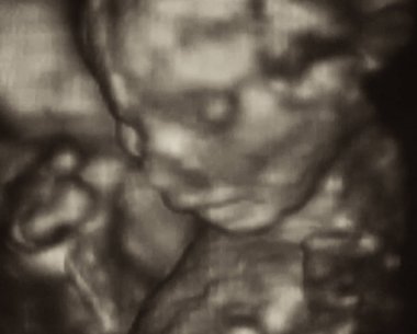 4. Fetüs 'ün Ultrasonografi Analizi, İtalya