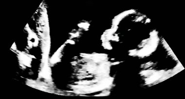 Annenin rahim içinde bebek ultrason. Ultrasonografi, echogr