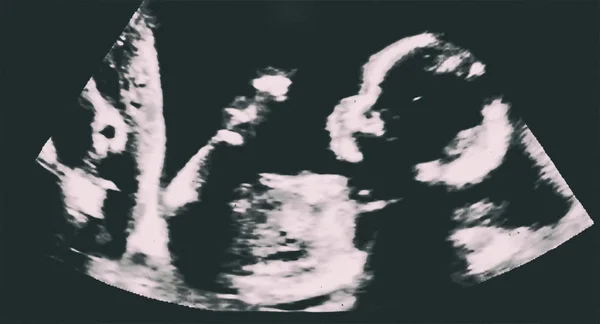 Υπερηχογράφημα μωρού μέσα στη μήτρα της μητέρας. Υπερηχογραφία, ηχοκαρδιογράφημα — Φωτογραφία Αρχείου