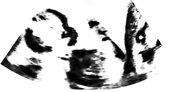 Ultrazvuk fetus. Matčino lůna. Ultrasonografie, echografie — Stock fotografie