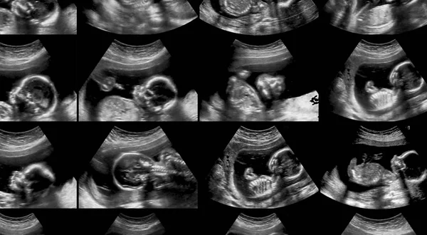 Collection of ultrasonography fetus scans — Stock Photo, Image