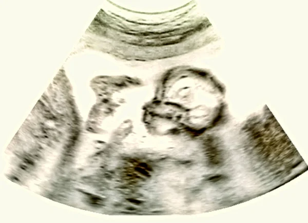 Ultrasound image of baby in mother's womb — Stock Photo, Image