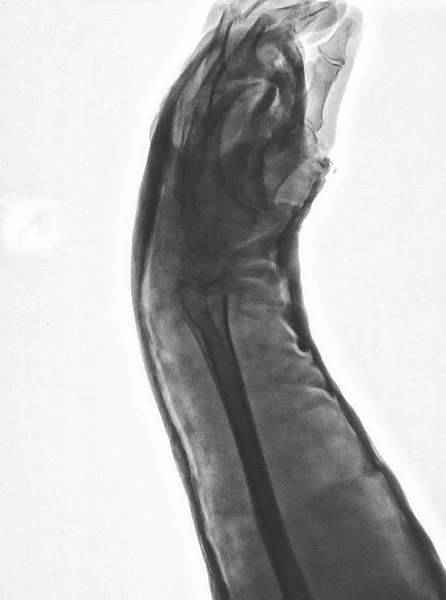 Digital radiography of arm and hand. X ray of left side