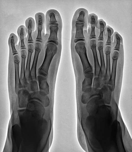 Raios-X de pés humanos. Vista superior — Fotografia de Stock