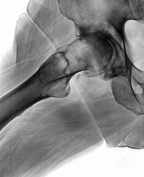 Röntgen av bäckenet och ryggraden hos en man — Stockfoto