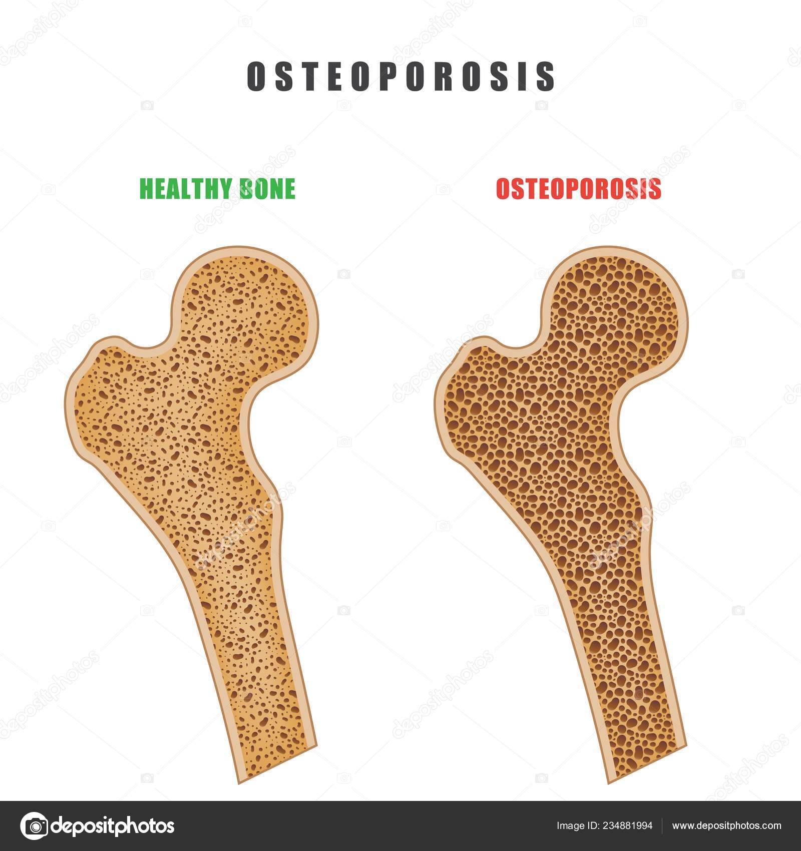 Color Drawing Human Thigh Bone Osteoporosis Problem White Background Two Stock Vector Image by ©lapotnik #234881994 Color Drawing Human Thigh Bone Osteoporosis Problem White Background Two Stock Vector Image by ©lapotnik #234881994