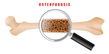 İnsan uyluk kemiği osteoporoz sorun ile çizim beyaz arka plan üzerinde renkli. İki kemik normal ve boğaz vardır. Osteoporoz hastalığının tıbbi sorun vektör çizim