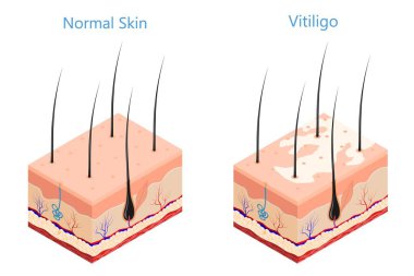 Cut human skin in isometric style on a white background isolated  Medicine problem skin vitiligo Vector illustration of vitiligo disease and healthy skin poster for the study of medical subjects clipart