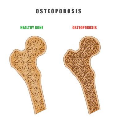 İnsan uyluk kemiği osteoporoz sorun ile çizim beyaz arka plan üzerinde renkli. İki kemik normal ve boğaz vardır. Osteoporoz hastalığının tıbbi sorun vektör çizim