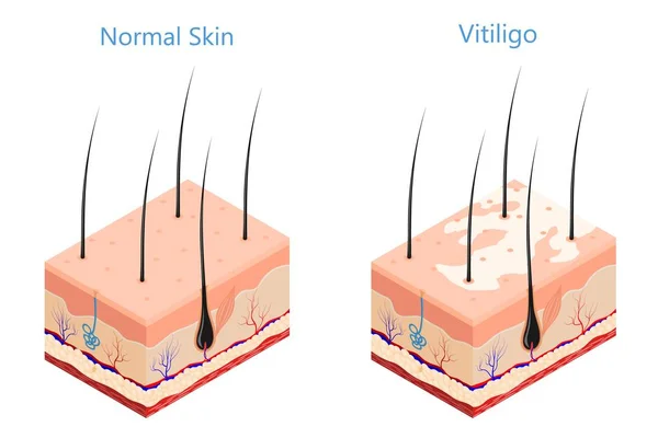 Corte Piel Humana Estilo Isométrico Sobre Fondo Blanco Aislado Problema — Vector de stock