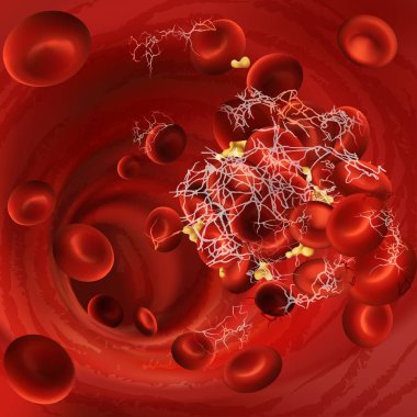 Bir kan pıhtısı, trombüsü veya emboli pıhtılaşmış kırmızı kan hücreleri, trombositler vücudun kan damarları ile vektör çizim