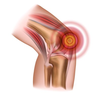 Diz ağrısı. Bacak, patella, diz eklemi yaralanması. Beyaz arka planda yalıtılmış vektör çizimi.