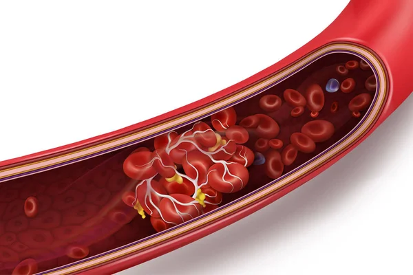 Caillot sanguin (thrombus) dans la veine. Illustration vectorielle 3d isolée sur fond blanc transparent . — Image vectorielle