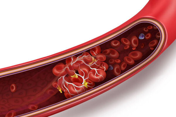 Blood clot (thrombus) in vein. Vector 3d illustration isolated on white transparent background.