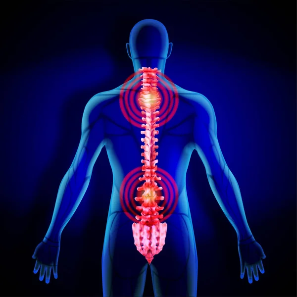 脊椎のX線 ヒトの脊椎への炎症 ベクターイラスト — ストックベクタ