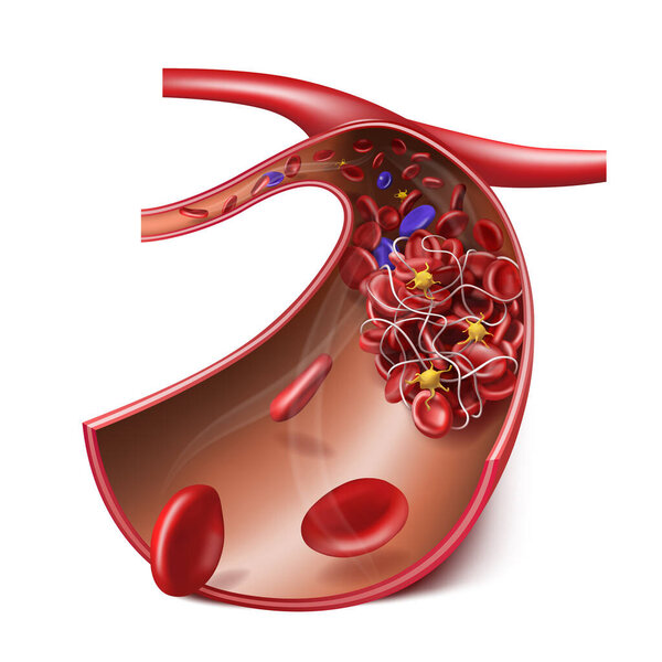 Blood clot and thrombosis. Medical illustration. 3d vector