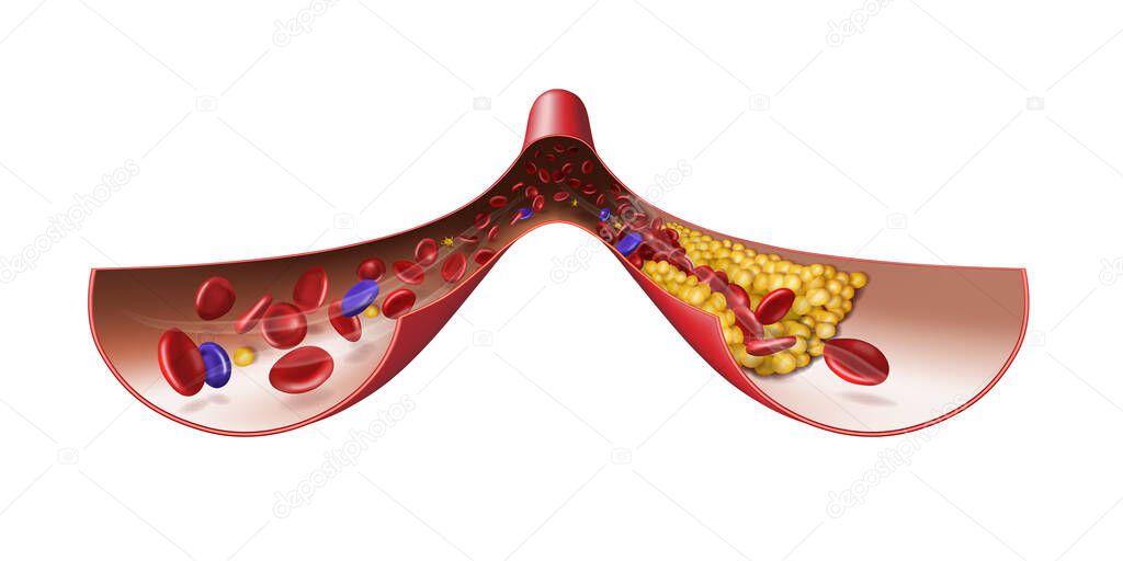 Normal vein and vein with cholesterol. Medical illustration. 3d vector