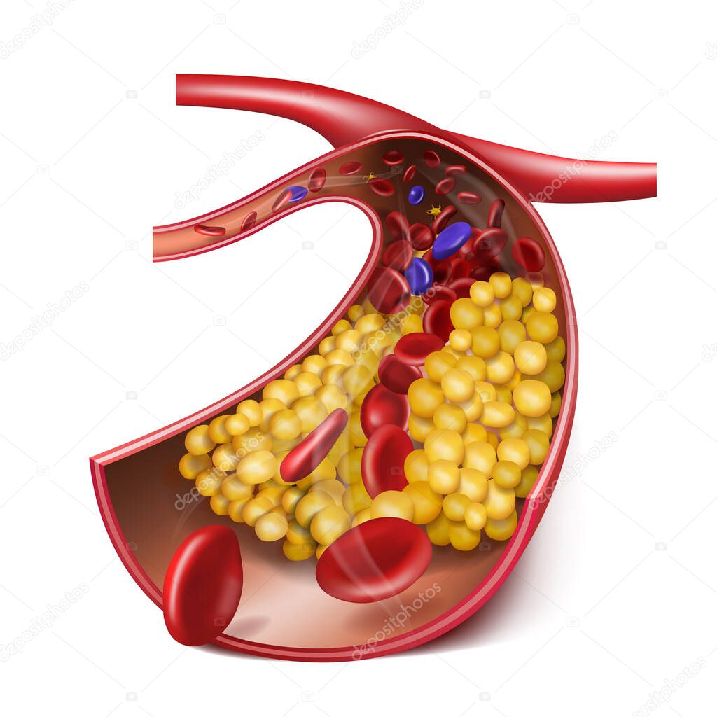 Vein with high cholesterol levels. Medical illustration. 3d vector