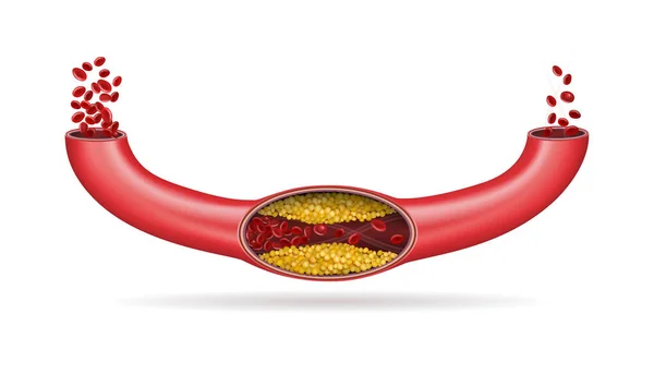 Arteria Bloccata Dal Colesterolo Illustrazione Vettoriale — Vettoriale Stock