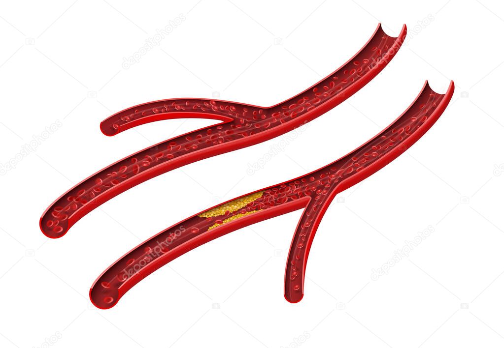Normal and cholesterol-blocked arteries on a white background. Vector illustration