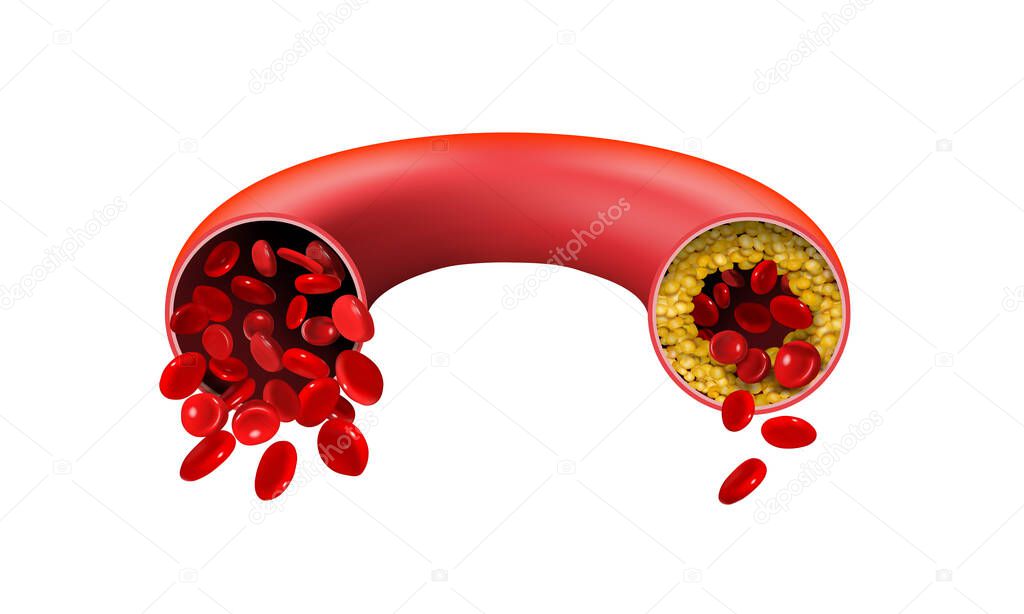 Normal and cholesterol-blocked artery on a white background. Vector illustration