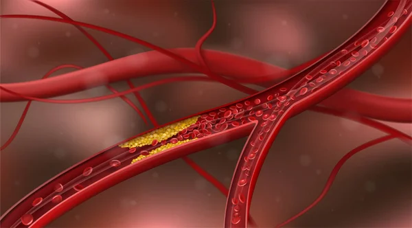 Tętnica Zablokowana Cholesterolem Ilustracja Wektora — Wektor stockowy